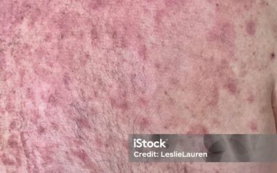 Eritema multiforme mayor vs. síndrome de Stevens-Johnson como toxicidad cutánea grave inmunorrelacionada en paciente con adenocarcinoma de pulmón