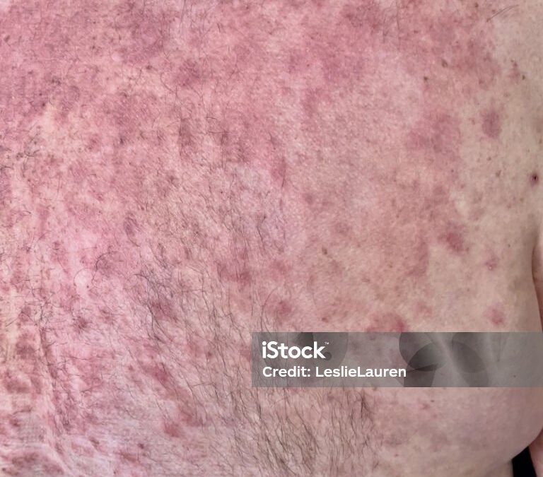 Eritema multiforme mayor vs. síndrome de Stevens-Johnson como toxicidad cutánea grave inmunorrelacionada en paciente con adenocarcinoma de pulmón